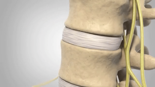 https://paulspine.com/wp-content/uploads/2021/06/herniated-disc-condition-animation-high.gif