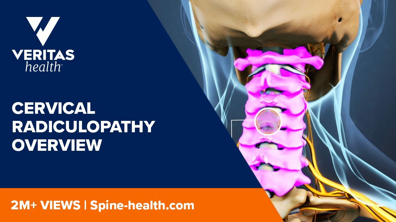 What Is Cervical Radiculopathy Dr Ronjon Paul 6779