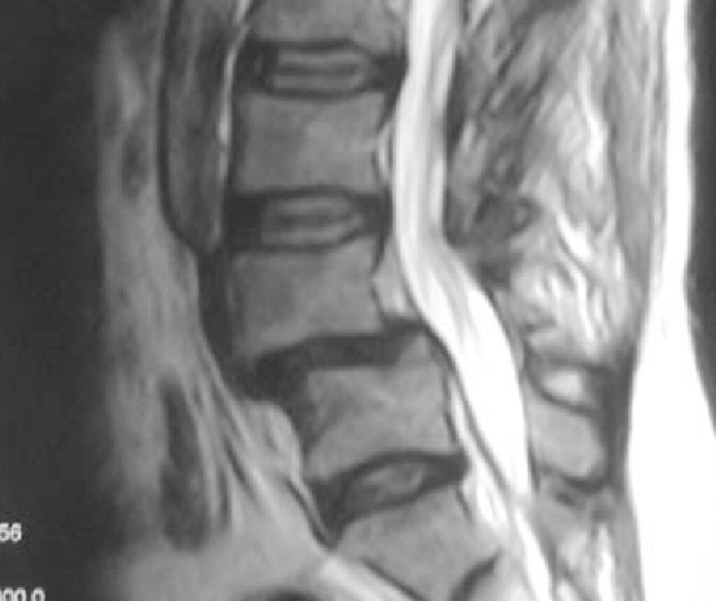 Spondylolisthesis MRI Image
