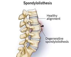 Lumbar Spondylolisthesis