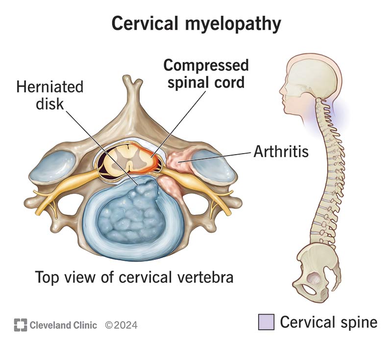 cervical-myelopathy