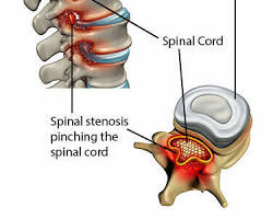 lumbar spinal stenosis