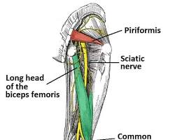 sciatica